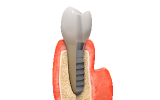 Les différentes étapes de la pose d'un implant dentaire
