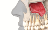 Les implants dentaires - Chirurgie préparatoire