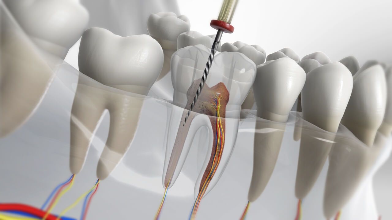 Traitement du canal de la dent - endodontie - dévitalisation