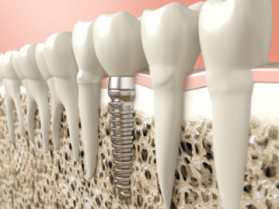 Ostéointégration de l'implant dentaire