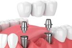 Prothèse dentaire sur implant