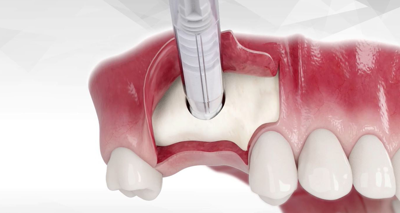 solution r&eacute;g&eacute;n&eacute;ratrice de greffe osseuse