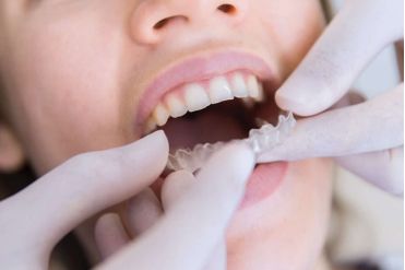 Dents parfaitement align&eacute;es, othodontie invisible