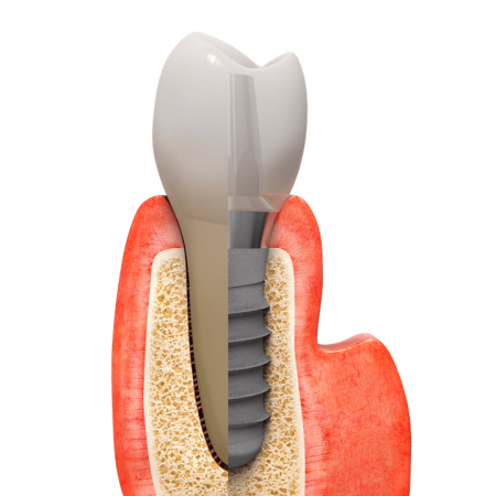 Comparaison dent-implant en vue transparente
