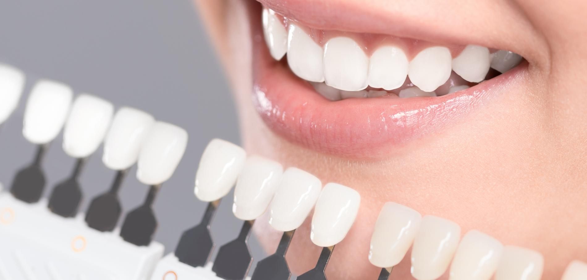 Blanchiment &eacute;claircissement dentaire professionnel chez soi