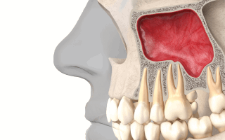 Chirurgie pr&eacute;paratoire - sinus lift