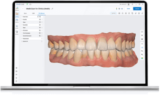 Prise d'empreinte dentaire digitale et chromatique