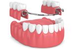 Prothèse dentaire amovible