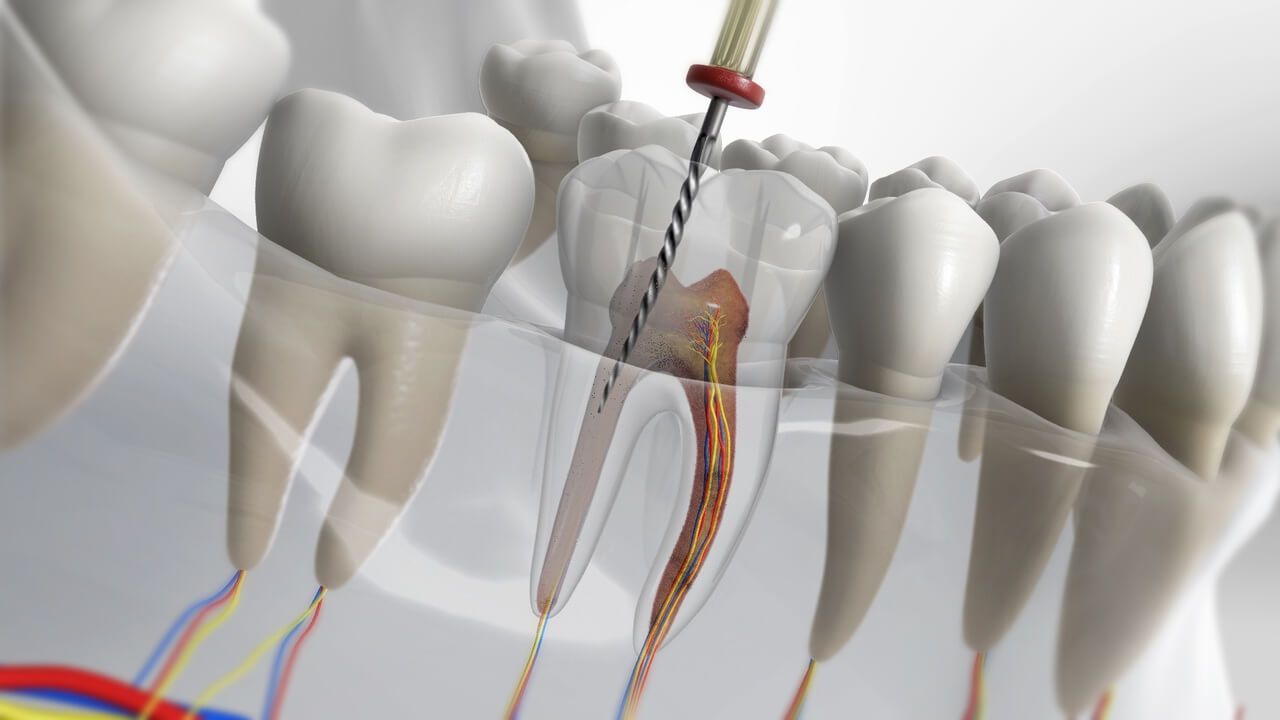 Traitement du canal de la dent - endodontie - d&eacute;vitalisation