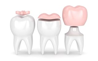 Prothèse dentaire fixe, couronne dentaire